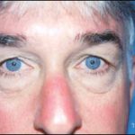 Blepharoplasty Before & After Patient #2454
