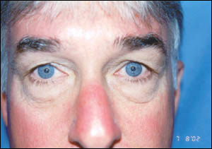 Blepharoplasty Before & After Patient #2454