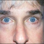 Blepharoplasty Before & After Patient #2454