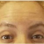 Botox Before & After Patient #2247