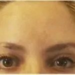 Botox Before & After Patient #2247