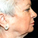 Facelift Before & After Patient #2450