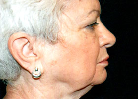 Facelift Before & After Patient #2450