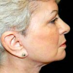 Facelift Before & After Patient #2450