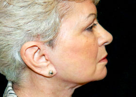 Facelift Before & After Patient #2450