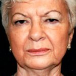 Facelift Before & After Patient #2450