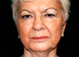 Facelift Before & After Patient #2450