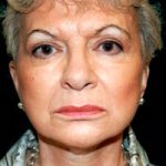 Facelift Before & After Patient #2450
