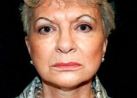 Facelift Before & After Patient #2450