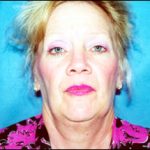 Facelift Before & After Patient #2446