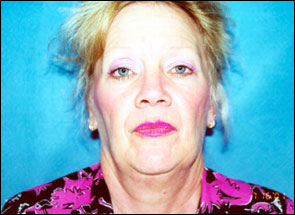 Facelift Before & After Patient #2446