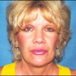 Facelift Before & After Patient #2446