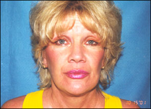 Facelift Before & After Patient #2446