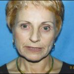 Facelift Before & After Patient #2447