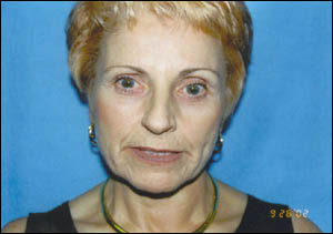 Facelift Before & After Patient #2447