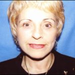 Facelift Before & After Patient #2447
