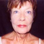 Facelift Before & After Patient #2448