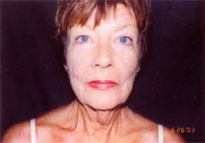 Facelift Before & After Patient #2448