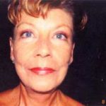 Facelift Before & After Patient #2448