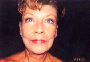 Facelift Before & After Patient #2448