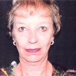 Facelift Before & After Patient #2449