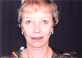 Facelift Before & After Patient #2449