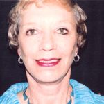 Facelift Before & After Patient #2449