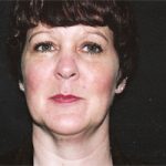 Facelift Before & After Patient #2443