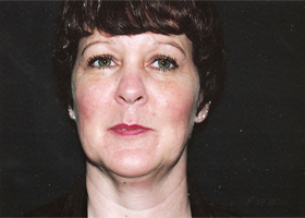 Facelift Before & After Patient #2443