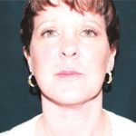 Facelift Before & After Patient #2443
