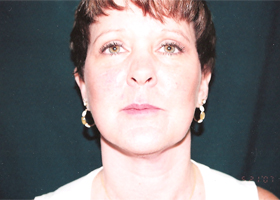 Facelift Before & After Patient #2443