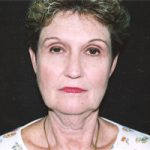 Facelift Before & After Patient #2444