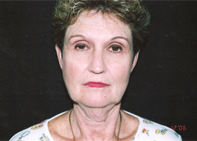 Facelift Before & After Patient #2444