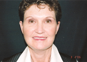 Facelift Before & After Patient #2444