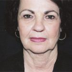 Facelift Before & After Patient #2445