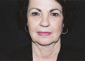 Facelift Before & After Patient #2445
