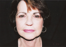 Facelift Before & After Patient #2445