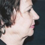 Facelift Before & After Patient #2445