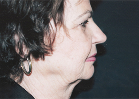 Facelift Before & After Patient #2445