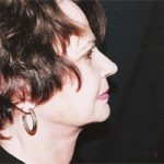 Facelift Before & After Patient #2445
