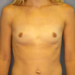 Breast Augmentation Before & After Patient #1469
