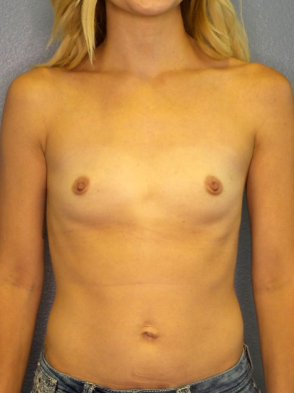 Breast Augmentation Before & After Patient #1469