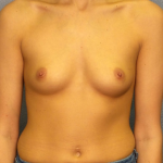 Breast Augmentation Before & After Patient #1517