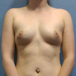 Breast Augmentation Before & After Patient #1549