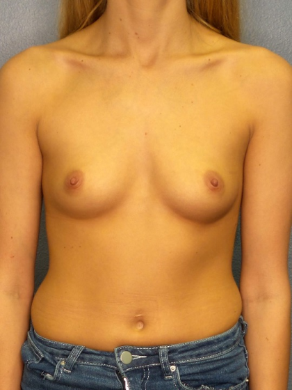 Breast Augmentation Before & After Patient #1517