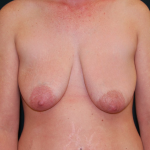 Breast Lift with Implant (Augmentation Mastopexy) Before & After Patient #1034