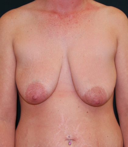 Breast Lift with Implant (Augmentation Mastopexy) Before & After Patient #1034