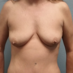 Mommy Makeover Before & After Patient #1964