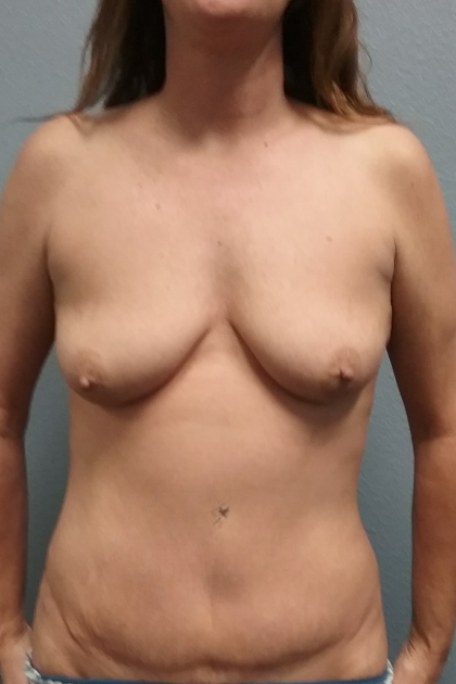 Mommy Makeover Before & After Patient #1964