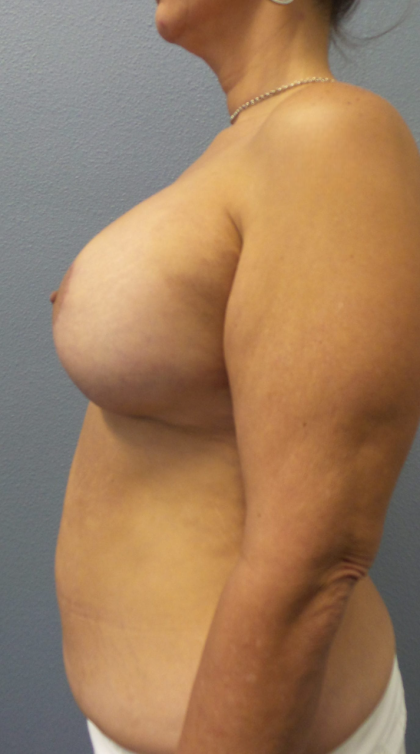 Mastopexy (Breast Lift) Before & After Patient #828